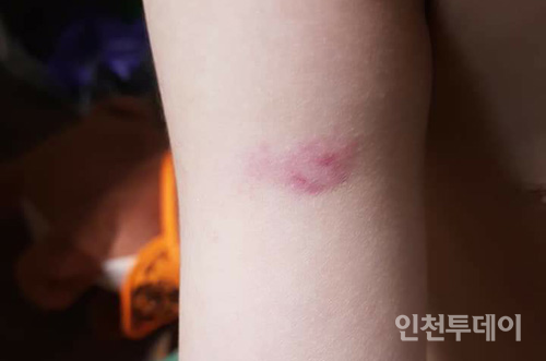 남동구 한 어린이집 교사로부터 꼬집힘을 당해 피멍이 든 아동의 팔.(인천투데이 자료사진)